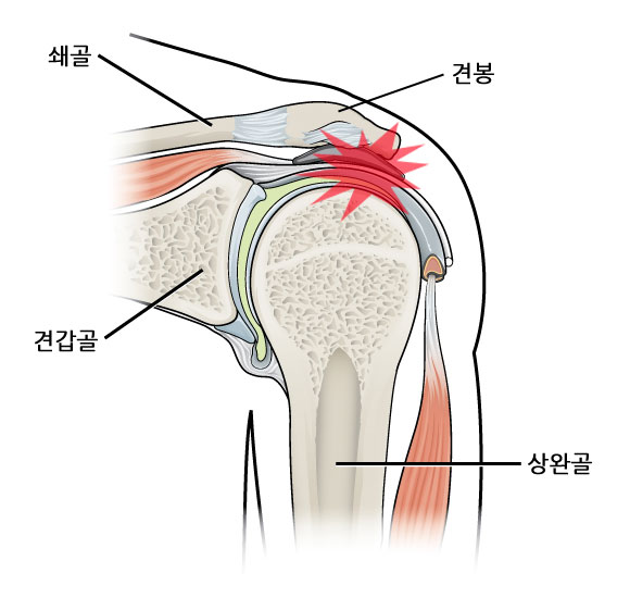 증후군 어깨 충돌 [트레이닝다이어리] 어깨